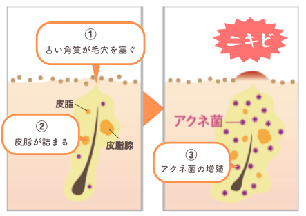 ニキビ｜サルチル酸マクロゴールピーリング｜ゆうスキンクリニック皮膚科